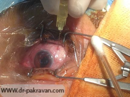 تزریق داخل چشمی باید در یک اتاق عمل کاملاً استریل انجام شود.